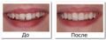 Стоматологическое наращивание зуба в DentalPark